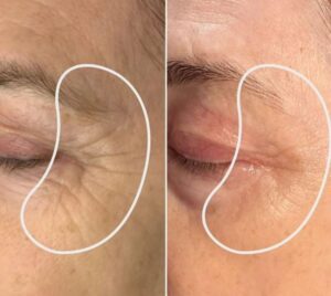 Comparison Between the before and after result of wrinkle treatment